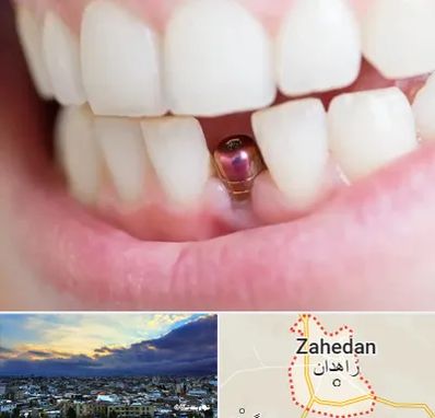 ایمپلنت اقساطی در زاهدان