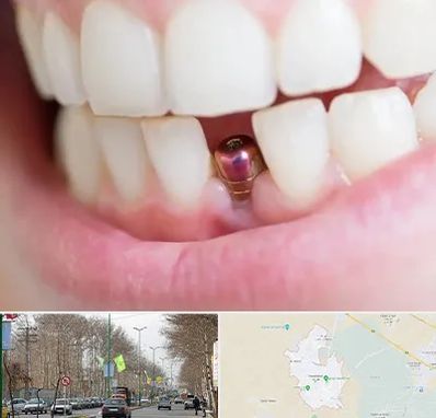 ایمپلنت اقساطی در نظرآباد کرج 