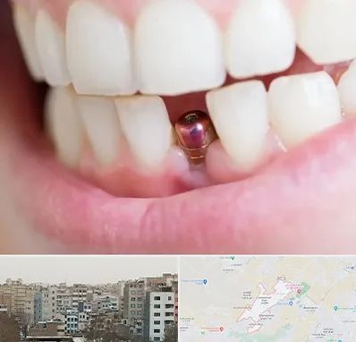 ایمپلنت اقساطی در محمد شهر کرج 