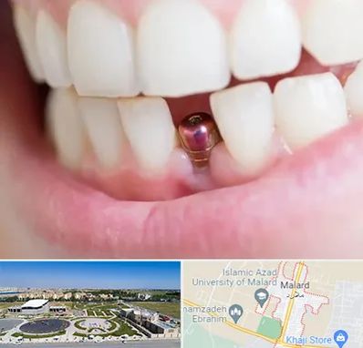 ایمپلنت اقساطی در ملارد