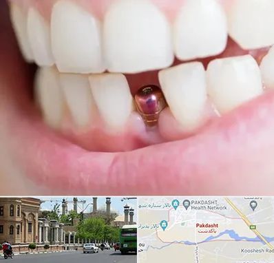 ایمپلنت اقساطی در پاکدشت