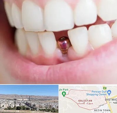 ایمپلنت اقساطی در شهرک گلستان شیراز