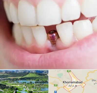 ایمپلنت اقساطی در خرم آباد