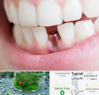 ایمپلنت اقساطی در تجریش 