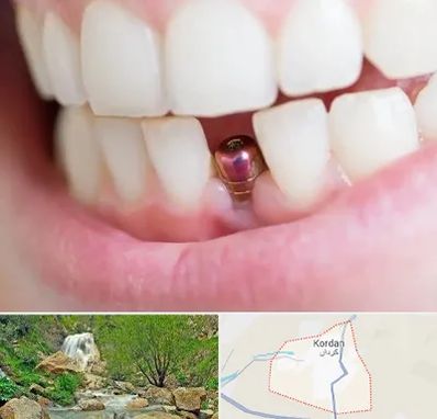 ایمپلنت اقساطی در کردان