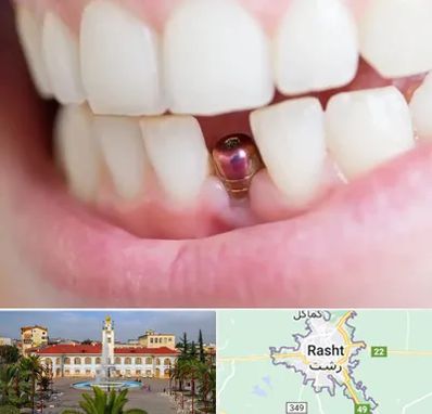 ایمپلنت اقساطی در رشت