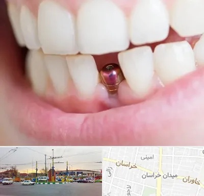 ایمپلنت اقساطی در میدان خراسان