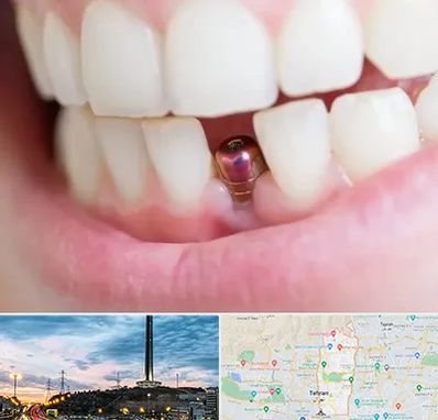 ایمپلنت اقساطی در منطقه 2 تهران 