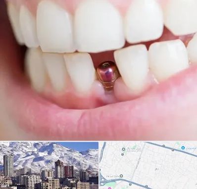 ایمپلنت اقساطی در ازگل