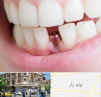 ایمپلنت اقساطی در لاله زار