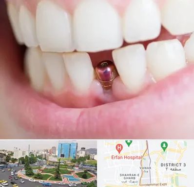 ایمپلنت اقساطی در ونک 