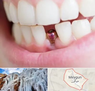 ایمپلنت اقساطی در میگون