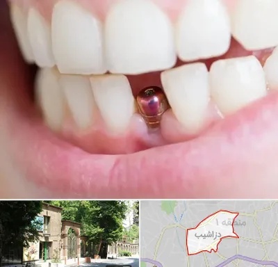 ایمپلنت اقساطی در دزاشیب