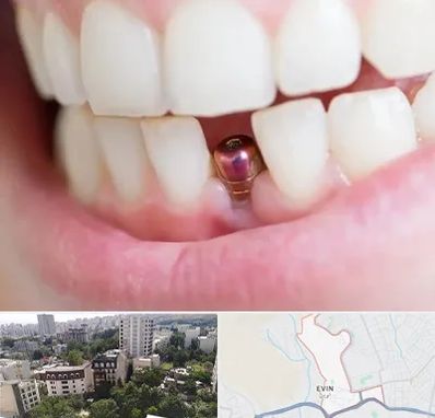 ایمپلنت اقساطی در اوین