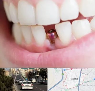 ایمپلنت اقساطی در خطیب تبریز