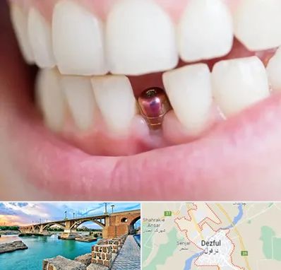ایمپلنت اقساطی در دزفول