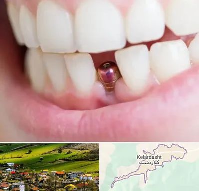 ایمپلنت اقساطی در کلاردشت
