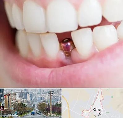 ایمپلنت اقساطی در گوهردشت کرج 