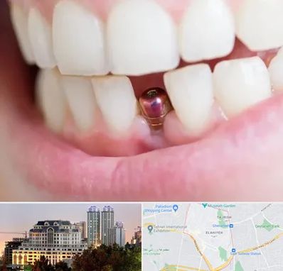 ایمپلنت اقساطی در فرشته 