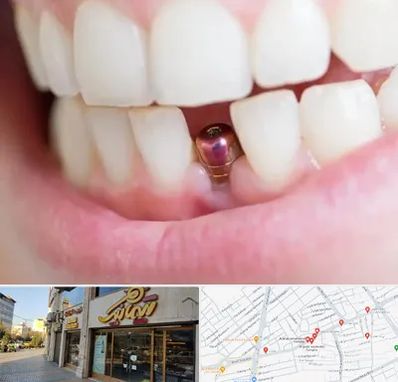 ایمپلنت اقساطی در عطاران قم