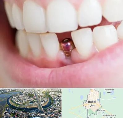 ایمپلنت اقساطی در بابل