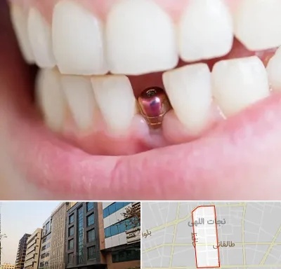 ایمپلنت اقساطی در نجات اللهی