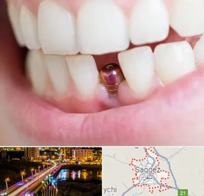 ایمپلنت اقساطی در سقز