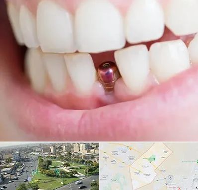 ایمپلنت اقساطی در کمال شهر کرج 