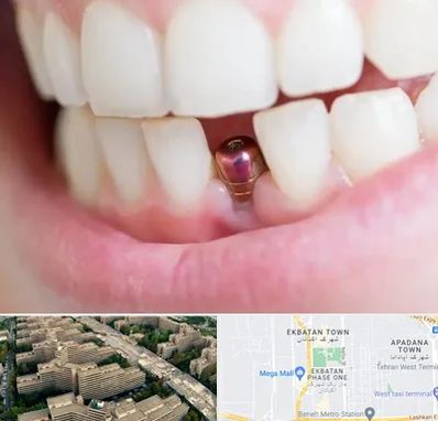 ایمپلنت اقساطی در اکباتان 