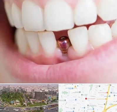 ایمپلنت اقساطی در آیت الله کاشانی 