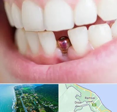 ایمپلنت اقساطی در رامسر