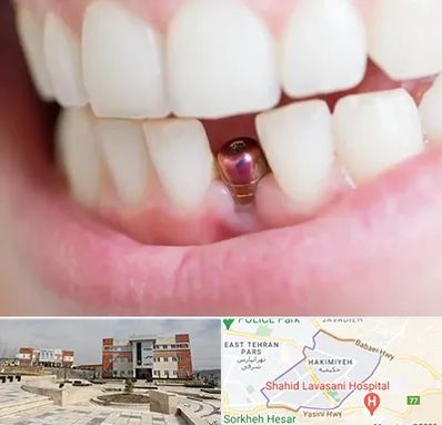 ایمپلنت اقساطی در حکیمیه 