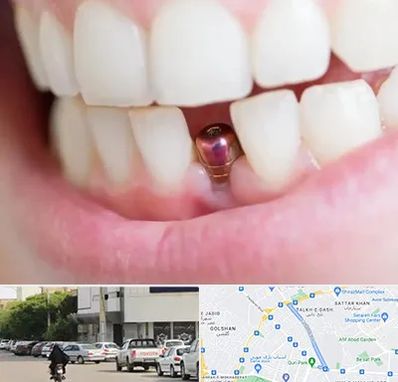 ایمپلنت اقساطی در قدوسی شرقی شیراز