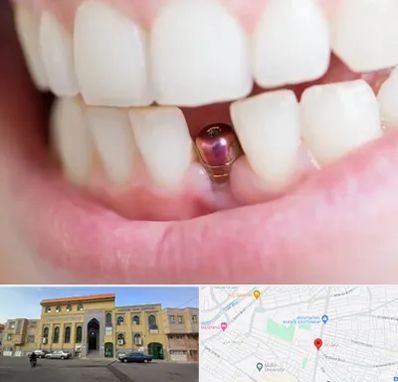 ایمپلنت اقساطی در زنبیل آباد قم