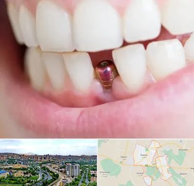 ایمپلنت اقساطی در شهریار