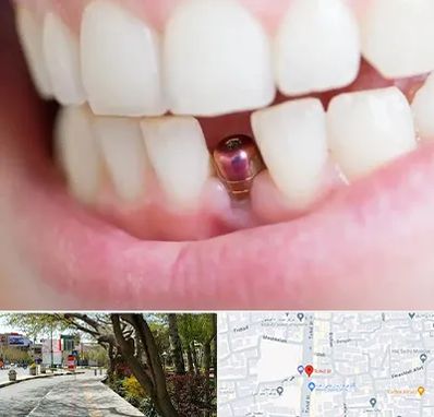 ایمپلنت اقساطی در خیابان توحید اصفهان