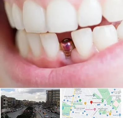 ایمپلنت اقساطی در بلوار فردوسی مشهد 