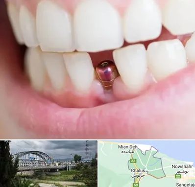 ایمپلنت اقساطی در چالوس