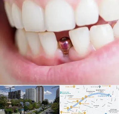 ایمپلنت اقساطی در اندرزگو 