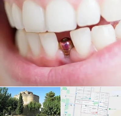 ایمپلنت اقساطی در مرداویج اصفهان