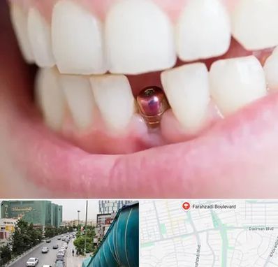 ایمپلنت اقساطی در بلوار فرحزادی