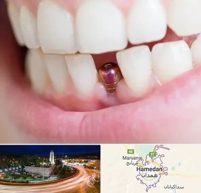 ایمپلنت اقساطی در همدان