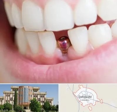 ایمپلنت اقساطی در دهدشت