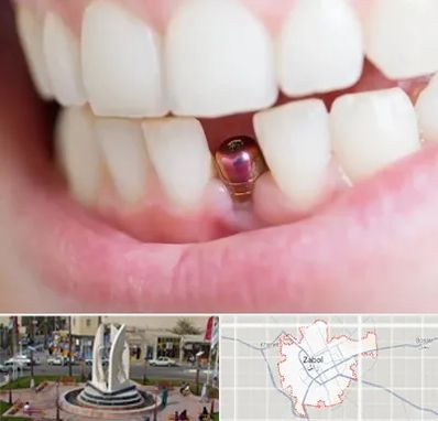 ایمپلنت اقساطی در زابل