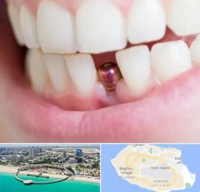 ایمپلنت اقساطی در کیش