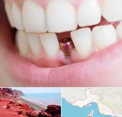 ایمپلنت اقساطی در هرمزگان
