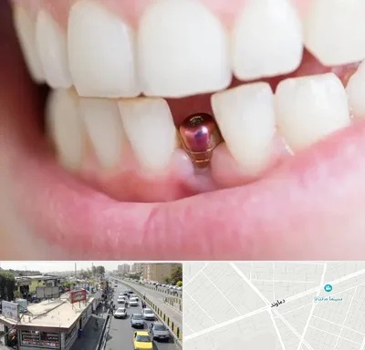 ایمپلنت اقساطی در خیابان دماوند