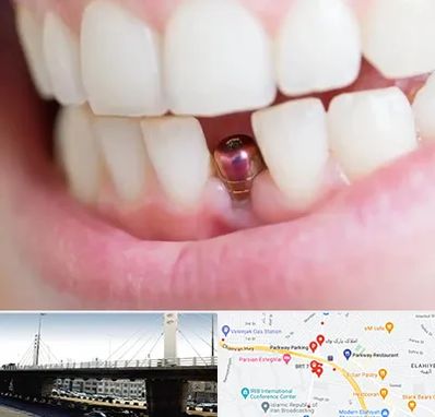 ایمپلنت اقساطی در پارک وی 