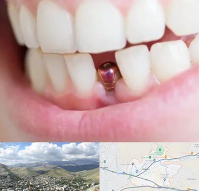 ایمپلنت اقساطی در رودهن