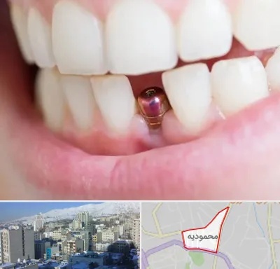 ایمپلنت اقساطی در محمودیه